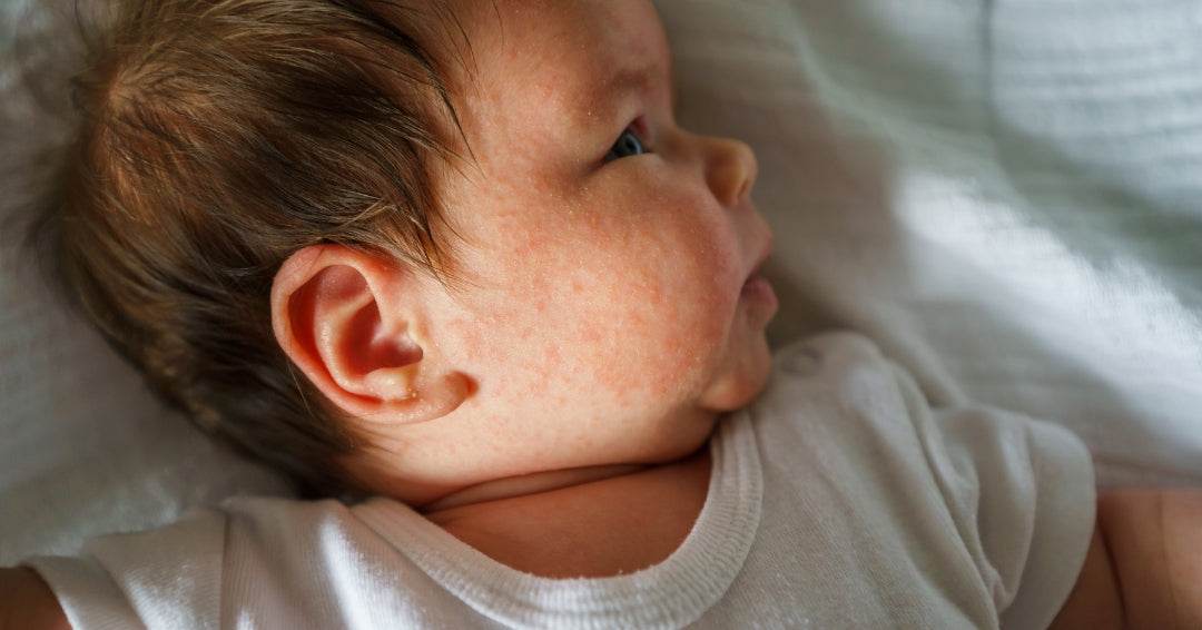 Neurodermitis bei Kindern - Teil 1